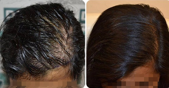Natural, fair density result from a female hair transplant case