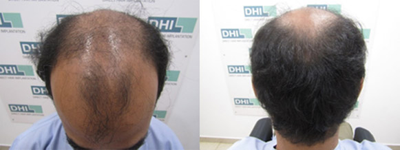 Hair Transplant of 7,000 Hairs in 7 hours only! | Dhi Mauritius